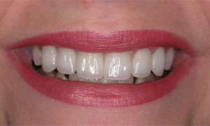 Bright smile after teeth whitening