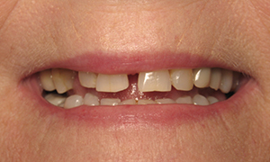 Gap between front teeth