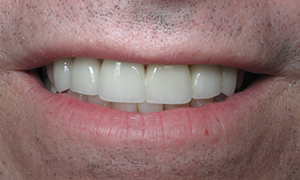 Flawless smile after treatment