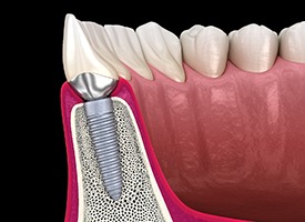 illustration of osseointegration representing how dental implants work in Kingwood