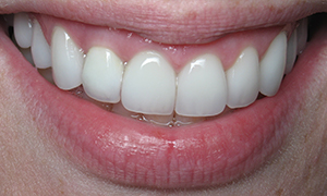Gorgeous smile after treatment