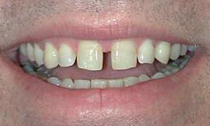 Large gap between front top teeth