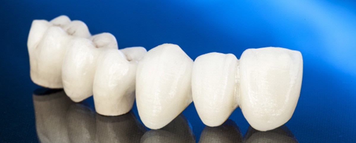 All-ceramic dental bridge