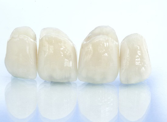 All-ceramic dental bridge for upper teeth