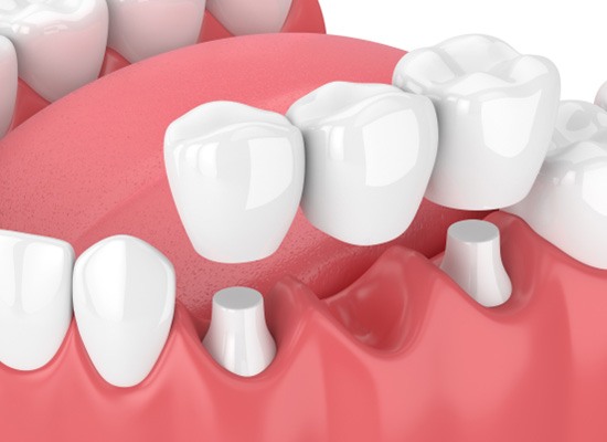 Model of fixed dental bridge