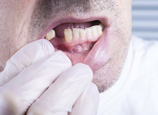 Man with a lower missing tooth