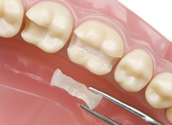 Model smile with inlay restoration