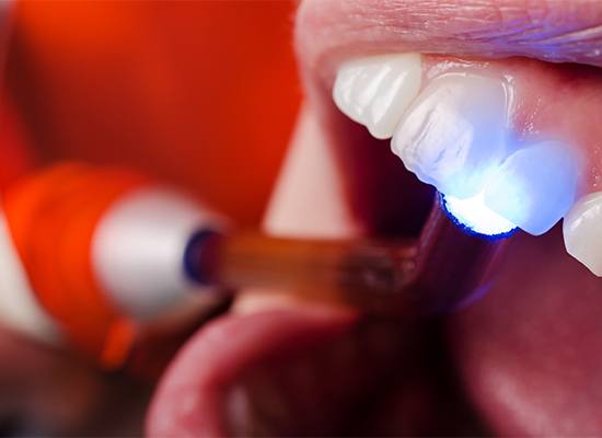 Closeup of patient receiving dental sealants