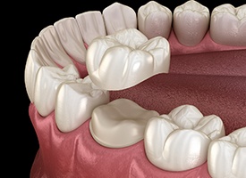 Personalized dental crown in Kingwood, TX being placed on tooth