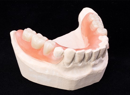 Smile model with partial denture restoration