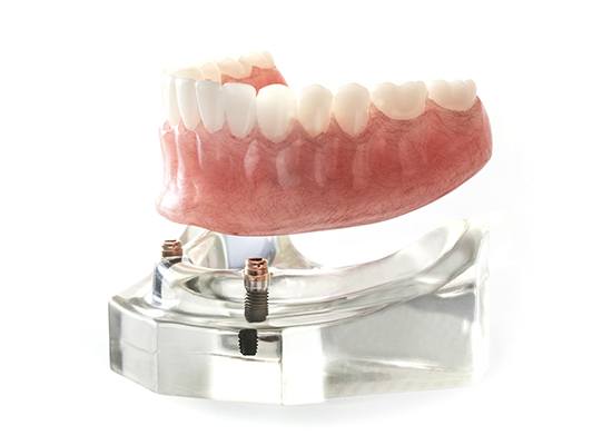 Implant supported denture model