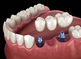 two dental implants supporting a dental bridge