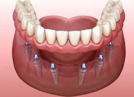 six dental implants supporting a full denture