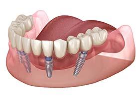 All-on-4 implant denture