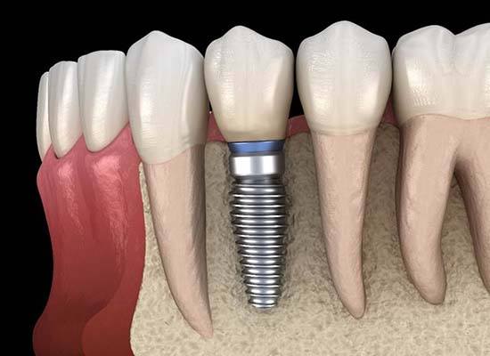 jawbone of a person with dental implants in Kingwood