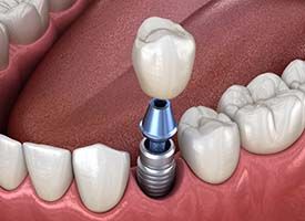 single dental implant with a crown on it