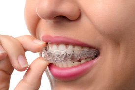 a person wearing clear aligners in Kingwood