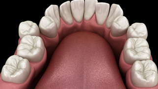 Illustration of crooked teeth