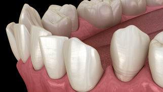 Illustration of gapped teeth