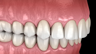 Illustration of an overbite