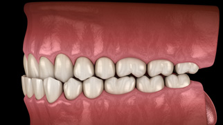 Illustration of a crossbite