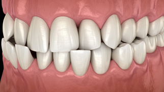 Illustration of an open bite