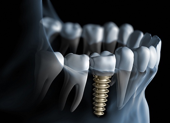 Animation of implant supported replacement tooth