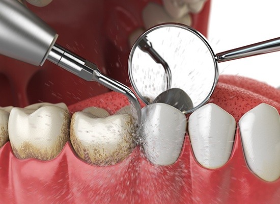 Animation of full mouth debridement