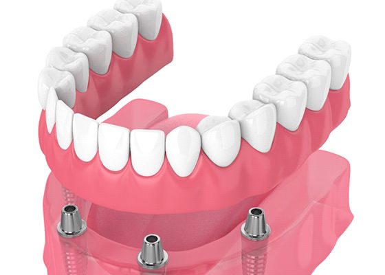 Dental implant dentures