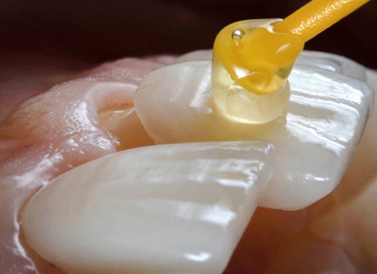 porcelain veneer being placed on a tooth