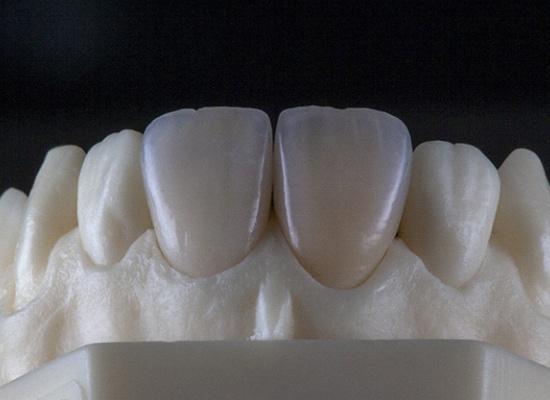 model of porcelain veneers on teeth