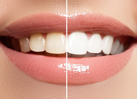Closeup of teeth whitening before and after