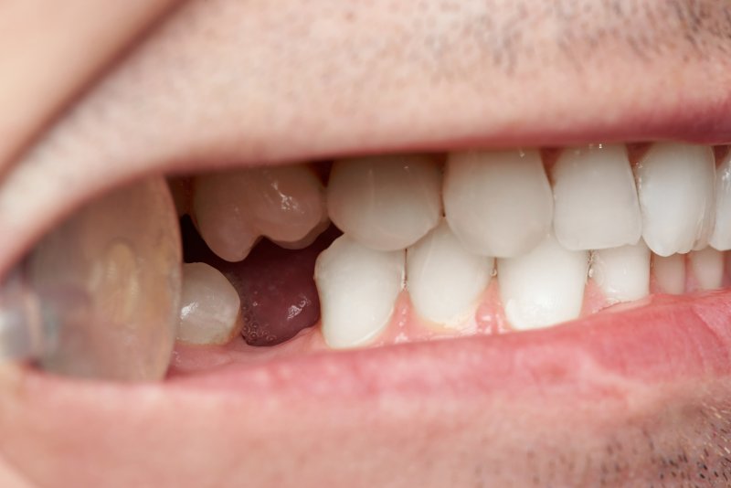 Close-up of a man missing his back tooth