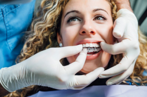 Dentist fitting a patient’s top Invisalign tray